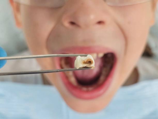 Best Emergency Wisdom Teeth Removal in Wooster, OH